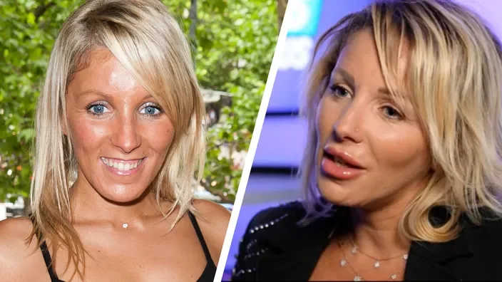 Myriam Abel avant apres la chirurgie esthétique 