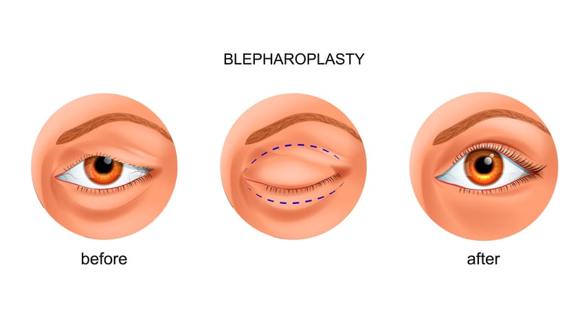 prix blepharoplastie tunisie pas cher