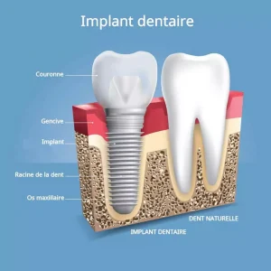 Implant dentaire Tunisie prix