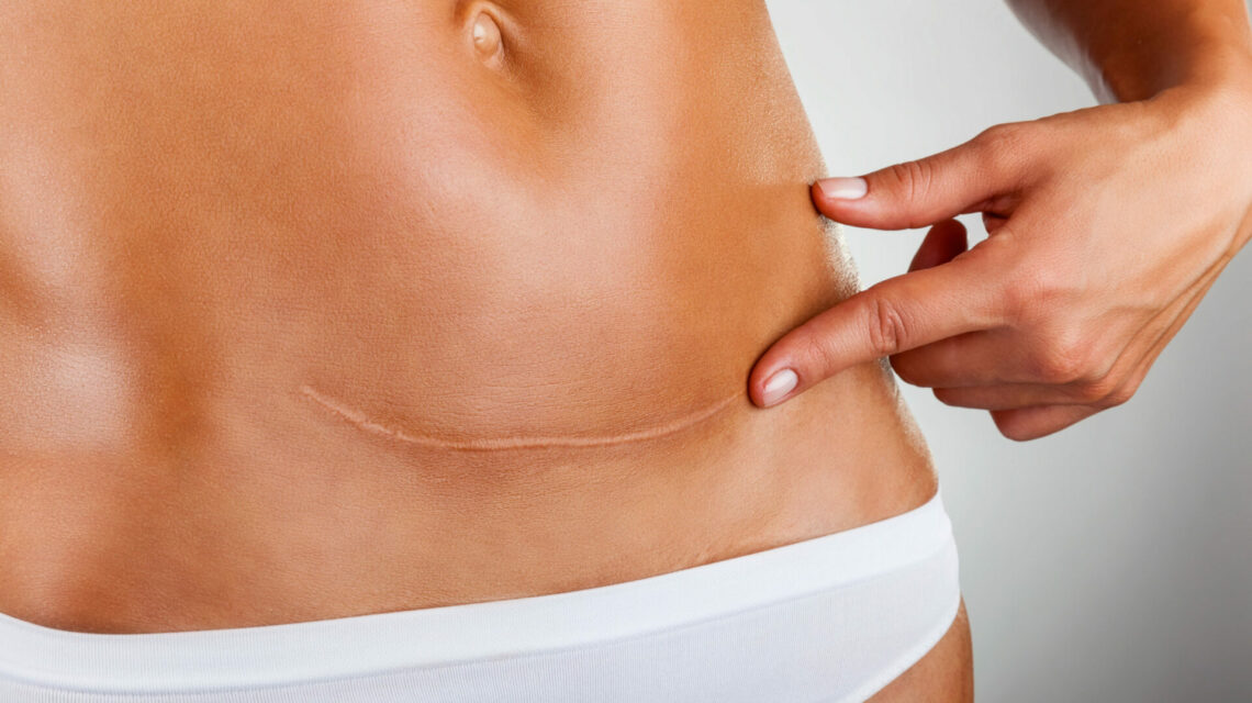 abdominoplastie cicatrice