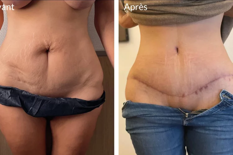 abdominoplastie-cicatrices-6-mois