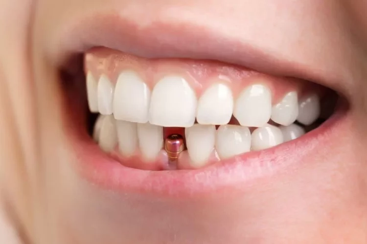 Implant dentaire Tunisie prix