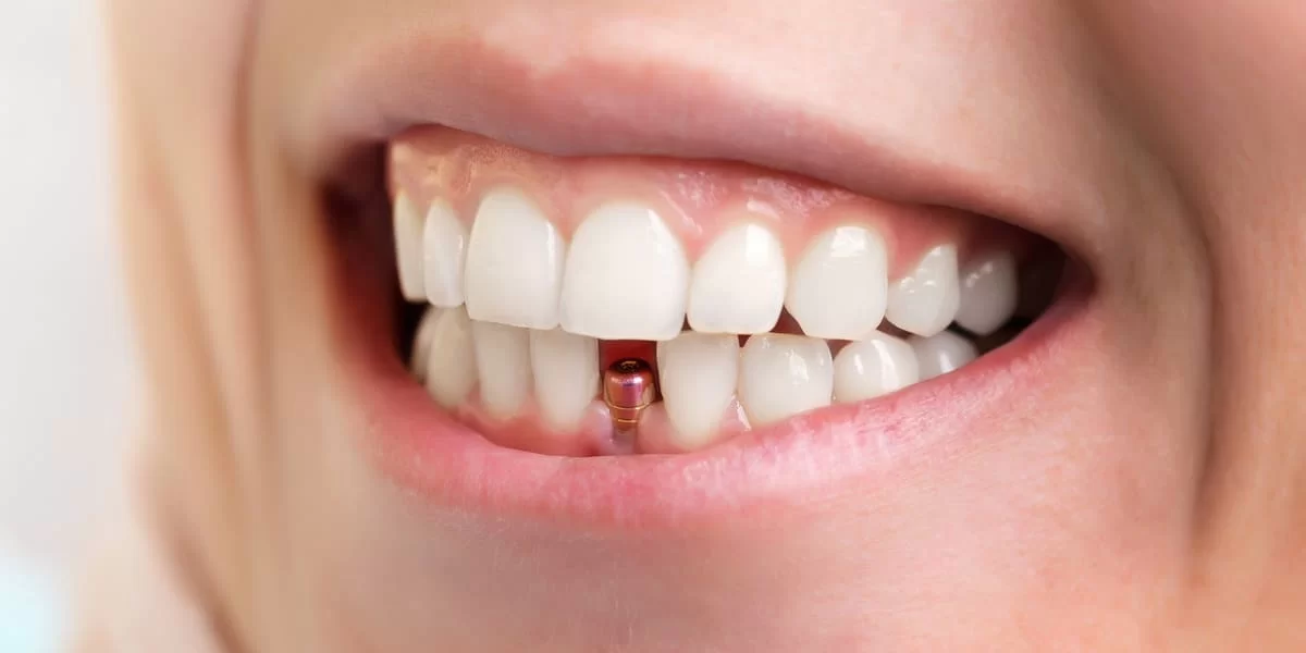 Implant dentaire Tunisie prix