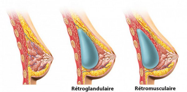 Augmentation mammaire par pose de prothèses