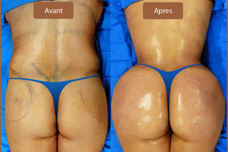 Patiente 1 : Photos avant après le lipofilling fessier en Tunisie