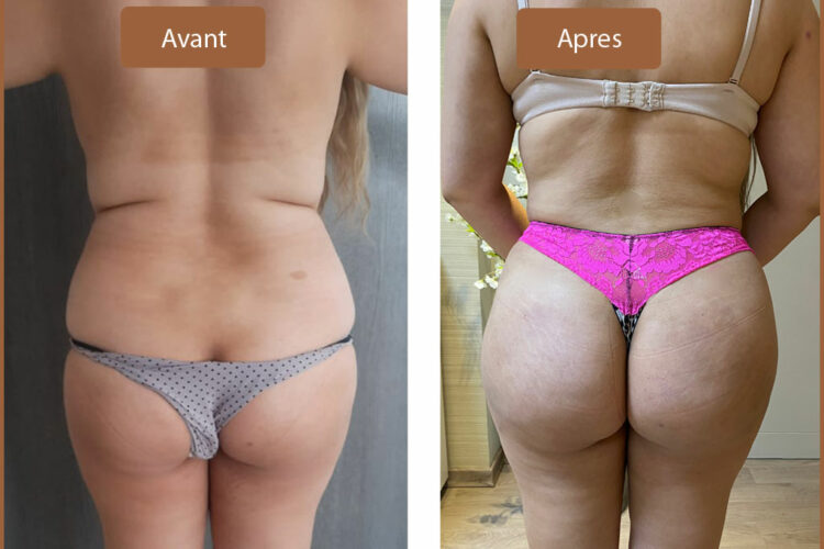 Patiente 1 : Photos avant après le lipofilling fessier en Tunisie