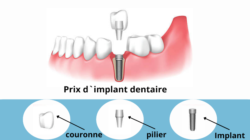 Prix implant dentaire France