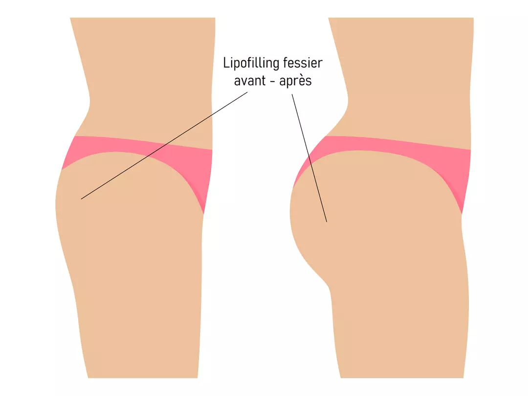 augmentation-des-fesses-par-lipofilling 