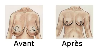 Prix Réduction mammaire en Tunisie