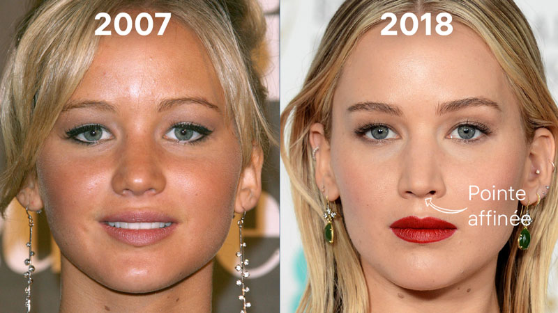 Jennifer Lawrence et la chirurgie esthétique